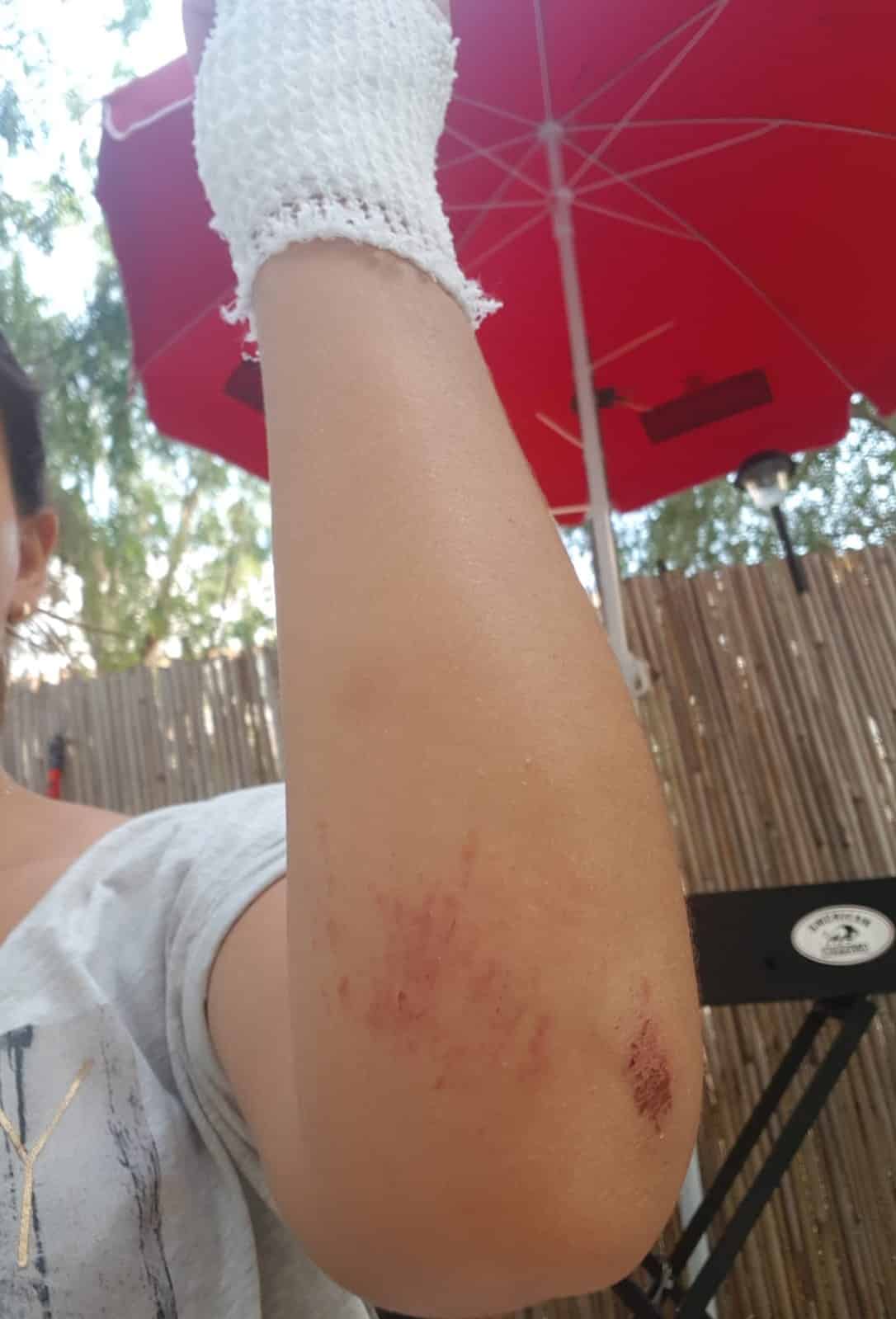 היד החבולה בעקבות האירוע