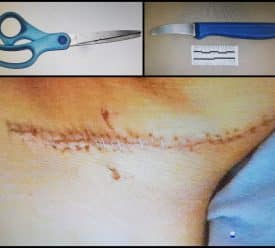 דקירת קטין בצוואר כפר סבא