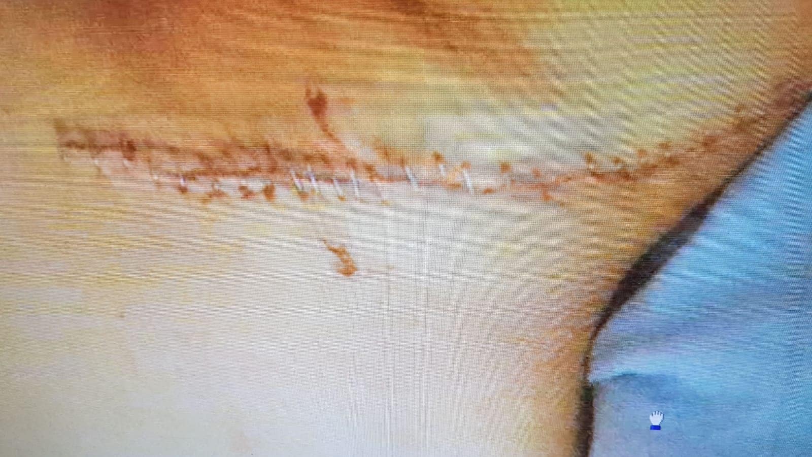 צווארו של הקטין שנדקר