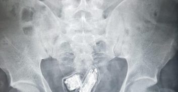 כלא עופר: עצור ניסה להבריח בתוך גופו ארבעה טלפונים סלולאריים