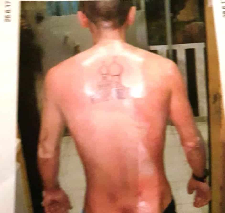 הכוויות על גבו של אזייב. צילום מתוך תיק החקירה של המשטרה