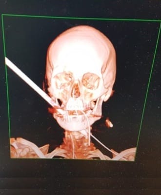 צילום סי-טי שבו נראה החץ בתוך פניו של נתנאל