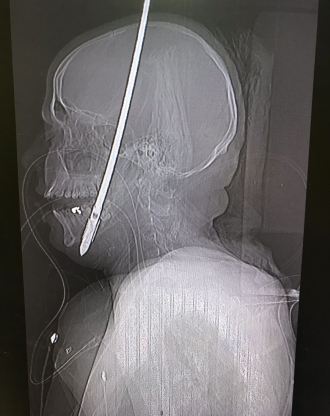 מבט נוסף לחץ בתוך הגולגולת