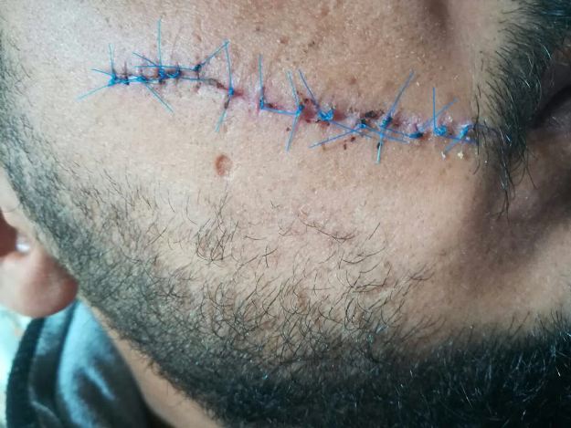 החתך והתפרים על לחיו של הנאשם