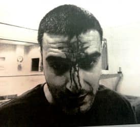 יעקב שרביט פצוע