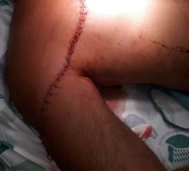 פציעת בליין מועדון הסלינה 1