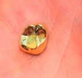 הפורץ שגנב שיניים מזהב: הרווחתי אותן בהימורים