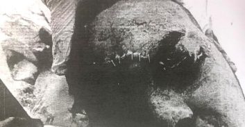 שבר בקבוק בירה על ראשו של חברו, שאיבד את הראייה