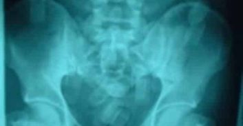 עוד אזרח ניגרי נתפס בניסיון להבריח עשרות זרגי קוקאין בגופו