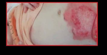 התינוקת נכוותה במקלחת, המטפלת לא הורשעה ברשלנות