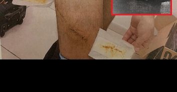 הנאשם דקר עם מברג? ההגנה הוכיחה שפציעות הקורבן לא מתאימות