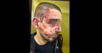 מוכר למשטרה נעצר על תקיפת שוטרים ואושפז עם שברים בצלעות