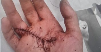 בריונות בכביש: חילופי קללות הסתיימו בחיתוך כף היד