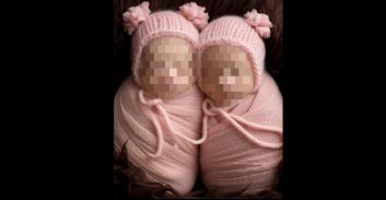 פיצויים של 9.7 מיליון שקל לצעירות שנולדו כתאומות סיאמיות